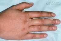 Hướng dẫn cách trị mụn cóc tại nhà