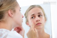 Sạch mụn trứng cá trong 1 tuần chỉ với 3 nghìn đồng