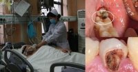 Chết thảm vì... sâu răng
