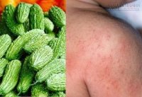 Nhất định các mẹ phải biết khi trị rôm sảy cho trẻ bằng mướp đắng