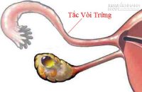 Căn bệnh âm thầm gây vô sinh nhiều người mắc phải mà không biết