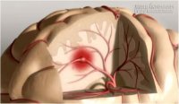 Tai biến mạch máu Não – Cái chết không báo trước