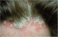 Trị dứt điểm vẩy nến bằng bài thuốc dân gian