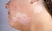 Trị tận gốc lang ben với 3 bài thuốc dân gian