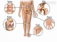 Bệnh đau khớp-Nguyên nhân và cách phòng bệnh đau khớp