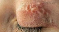Giun sán ký sinh, ăn ruỗng phổi, mắt, đục ngực người chui ra