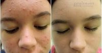 Tôi đã khỏi mụn 100% mà chẳng hề tốn kém