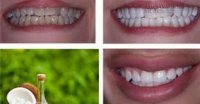 2 Phút làm trắng răng ấn tượng bằng dầu dừa