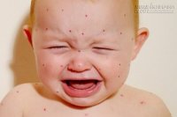 Một vài điều bạn cân biết về sốt virus ở trẻ em