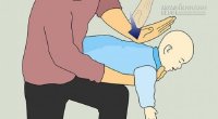 Xử trí gấp khi trẻ hóc dị vật