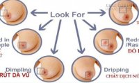 Thủ phạm âm thầm gây nên căn bệnh ung thư vú
