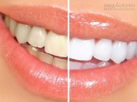 Bí quyết để răng trắng không cần kem đánh răng