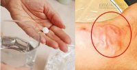 Sai lầm nguy hiểm khi uống thuốc tẩy giun mà nhiều người mắc phải