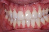 Căn bệnh dễ gây… rụng răng nhiều người mắc mà không để ý