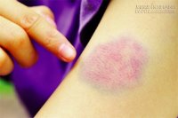 Những lý do khiến cơ thể bạn dễ xuất hiện những vết bầm tím mà bạn không biết tại sao?