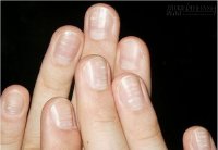 Những dấu hiệu giật mình ở móng tay báo bệnh trong cơ thể
