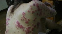 Giật mình sức tàn phá trên cơ thể người của bệnh giang mai