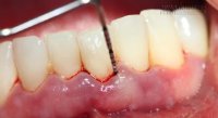 Căn bệnh dễ gây... rụng răng nhiều người mắc mà không để ý