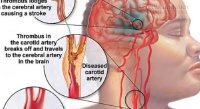 Dấu hiệu nhận ra người sắp bị đột quỵ