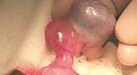 Căn bệnh nghiêm trọng chậm một giây có thể vô sinh cả đời