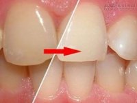 Bí quyết để có được hàm răng trắng sáng