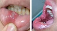Đắng lòng thanh niên rước lậu vào thân từ trào lưu hôn gái lạ