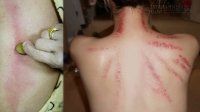 Những trường hợp không được cạo gió vì có thể gây chết người