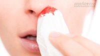 Tiểu xảo cầm máu cam an toàn cần phải nhớ phòng khi gặp phải