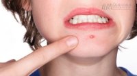 6 mẹo hay chữa các bệnh thường gặp tại nhà
