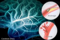 Khắc tinh cao huyết áp, tai biến và đột quị chính là đây !!!
