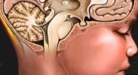Căn bệnh có thể gây tử vong ở trẻ mẹ Việt cần biết ngay