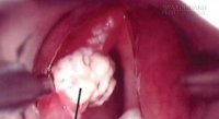 Căn bệnh nguy hiểm dễ dẫn tới ung thư có thể bạn đang mắc
