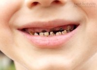 8 sai lầm kinh điển làm hỏng hàm răng xinh của bé