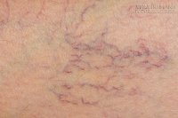 Mối hại không ngờ của thói quen ngồi vắt chéo chân