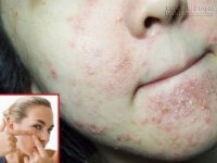 6 thói quen không ngờ khiến da bạn mãi không hết mụn