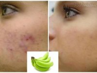 Tạm biệt sẹo thâm trong 1 tuần chỉ với chuối xanh