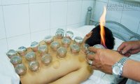 Những người này cấm tuyệt đối không được giác hơi nếu không muốn mất mạng