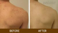 Tất tần tật các bí quyết trị mụn ở lưng đơn giản và hiệu quả