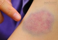4 cách đơn giản để làm mờ vết thâm tím