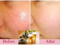 Tạm biệt lỗ chân lông to trong vòng 3 nốt nhạc với 4 mẹo dễ không tưởng