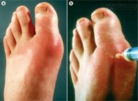 Đánh bay bệnh gút và đau khớp chỉ bằng loại nước ép này