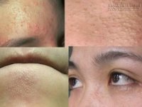 Đánh bay mụn ẩn li ti và se khít lỗ chân lông trong 1 tuần chỉ bằng cách xông hơi