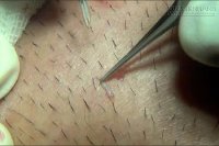 Hậu quả khôn lường khi nhổ lông nách bằng nhíp