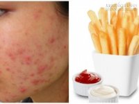 Những thực phẩm càng ăn càng nổi mụn