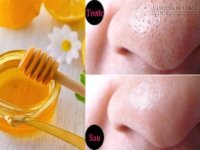 Phương pháp diệt sạch mụn đầu đen trong vòng 15 phút cực hiệu quả