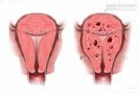Mắc bệnh phụ khoa này, bác sĩ phán cưới ngay, đẻ con gấp để trị bệnh