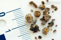 Tống sỏi thận ra ngoài trong 6 ngày không cần mổ với thứ duy nhất này