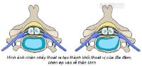 Những dấu hiệu bạn đã mắc đau thần kinh tọa hay thoát vị đĩa đệm