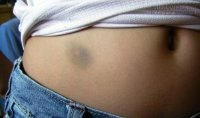Vết ma véo trên cơ thể là do đâu?