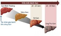 Nhiều đàn ông Việt gan lỗ chỗ như tổ ong vì sát thủ 3.000 đồng